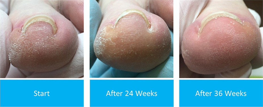 Active Ankle and Foot Care Specialist | Heel Spurs, Fungal Infections and MLS Laser Therapy