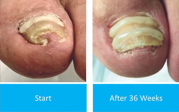 Active Ankle and Foot Care Specialist | Diabetic Foot Care, MLS Laser Therapy and Fungal Infections