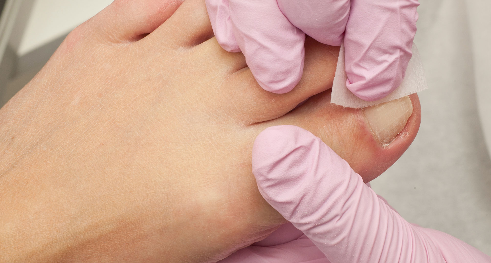 Fungal Nails Treatment in Johns Creek